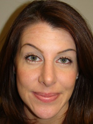 Rhinoplasty Before and After 03 | Grover Aesthetics