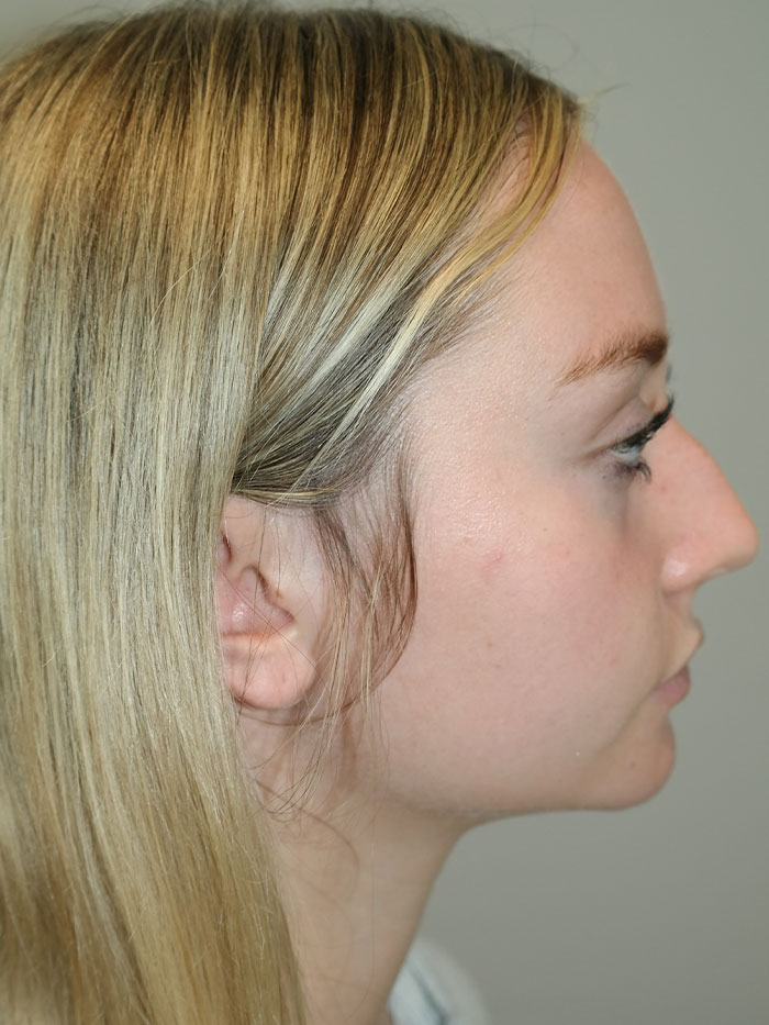 Rhinoplasty Before and After | Grover Aesthetics