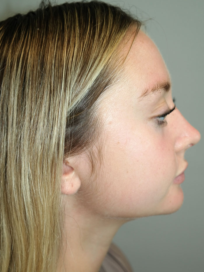 Rhinoplasty Before and After | Grover Aesthetics