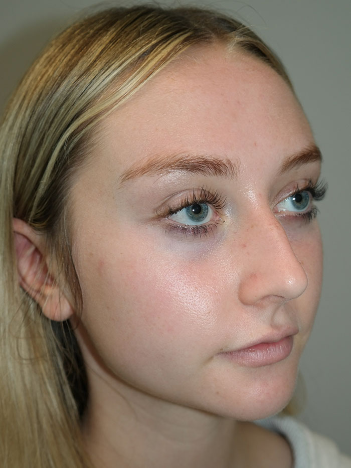 Rhinoplasty Before and After 04 | Grover Aesthetics