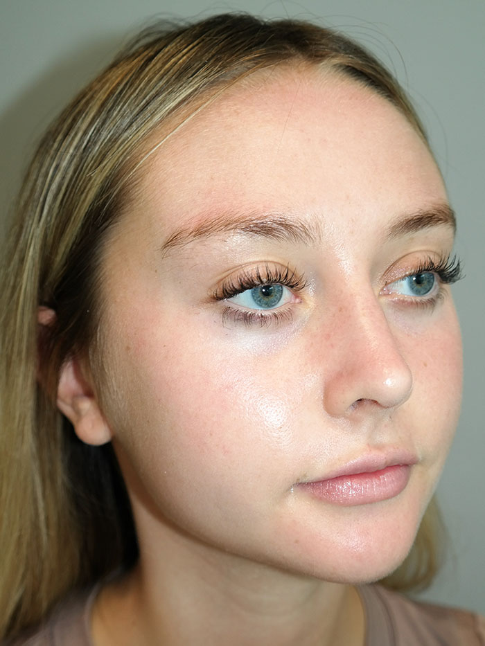Rhinoplasty Before and After 04 | Grover Aesthetics