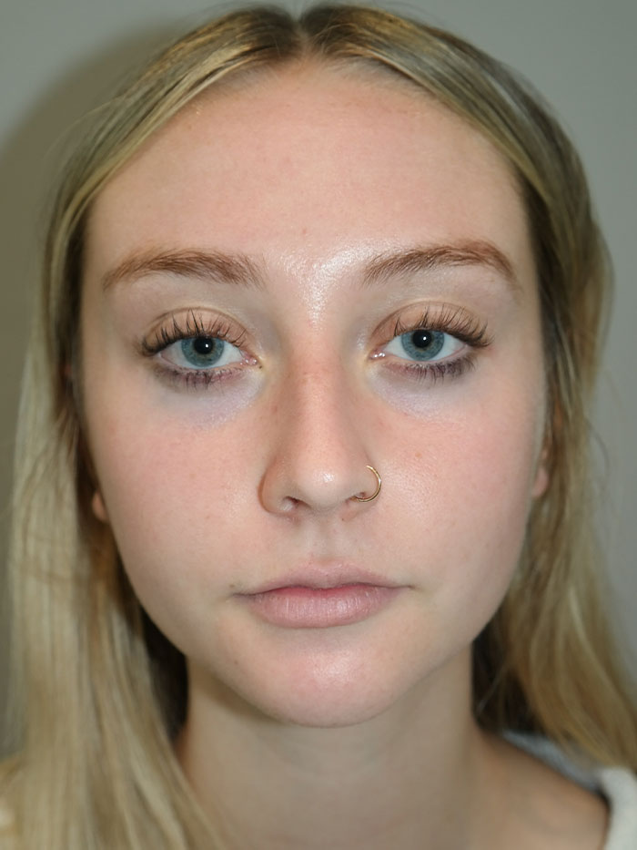 Rhinoplasty Before and After 04 | Grover Aesthetics