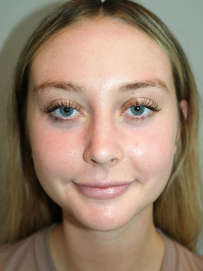 Rhinoplasty Before and After 04 | Grover Aesthetics