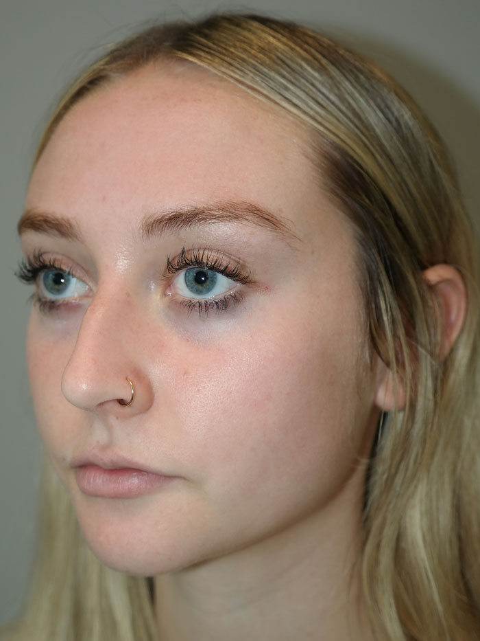 Rhinoplasty Before and After 04 | Grover Aesthetics