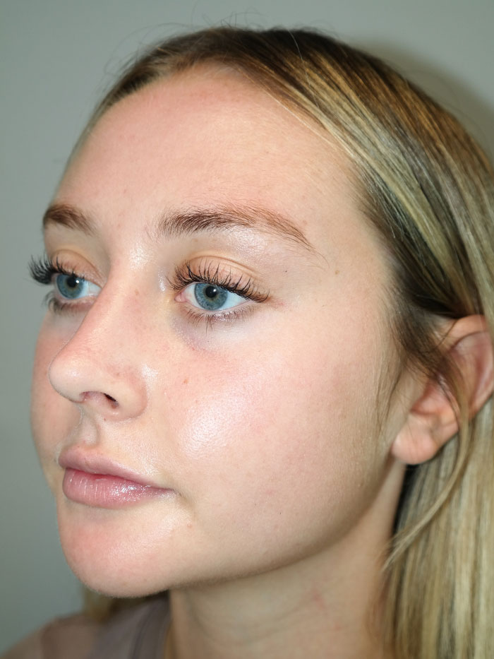 Rhinoplasty Before and After 04 | Grover Aesthetics