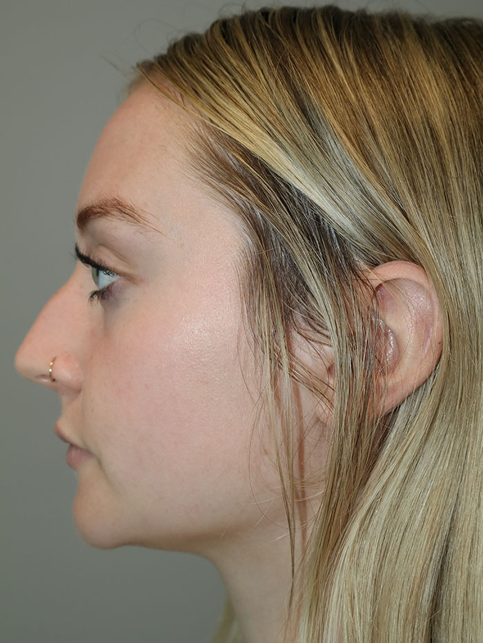 Rhinoplasty Before and After 04 | Grover Aesthetics