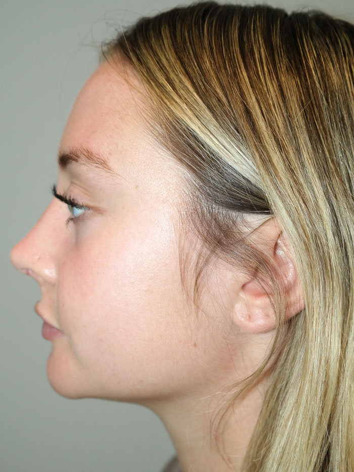 Rhinoplasty Before and After 04 | Grover Aesthetics