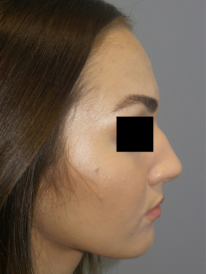 Rhinoplasty Before and After 38 | Sanjay Grover MD FACS