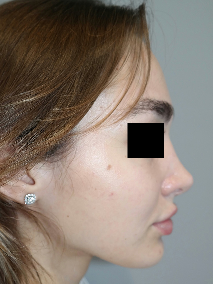 Rhinoplasty Before and After | Sanjay Grover MD FACS