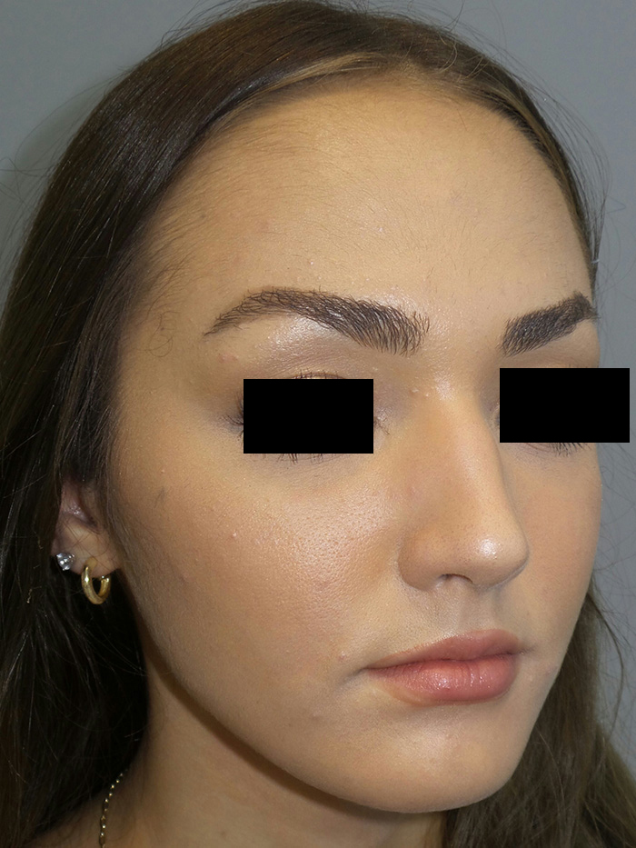 Rhinoplasty Before and After 05 | Sanjay Grover MD FACS