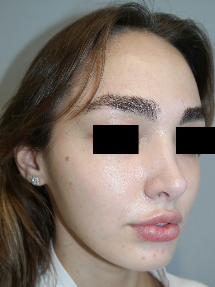 Rhinoplasty Before and After 05 | Sanjay Grover MD FACS