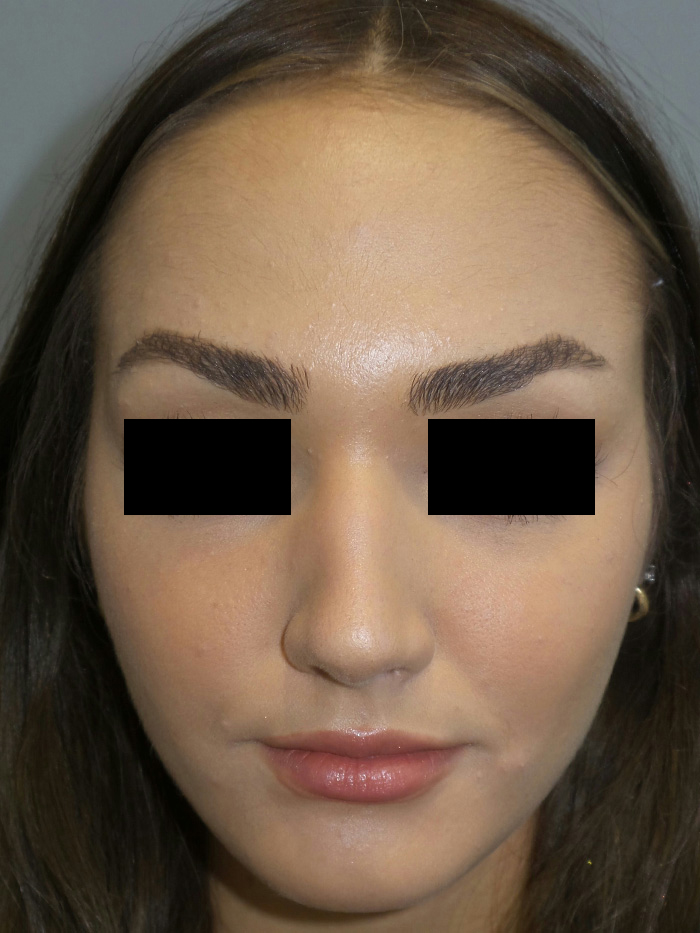 Rhinoplasty Before and After 05 | Grover Aesthetics