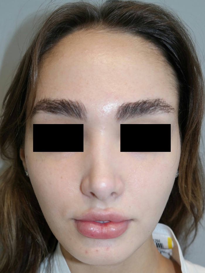 Rhinoplasty Before and After 05 | Grover Aesthetics