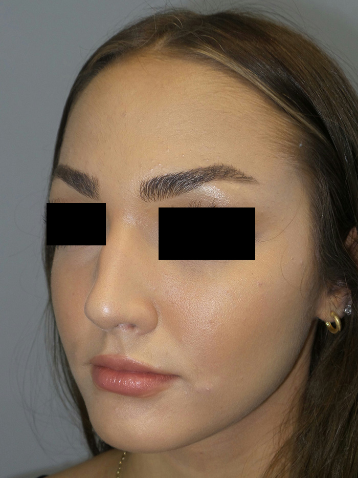 Rhinoplasty Before and After 05 | Grover Aesthetics