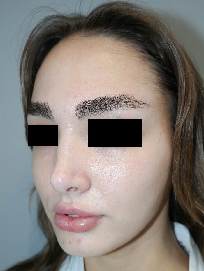 Rhinoplasty Before and After 05 | Grover Aesthetics