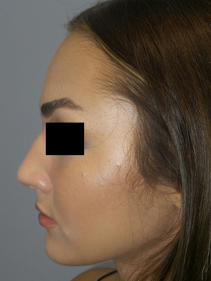 Rhinoplasty Before and After 05 | Grover Aesthetics