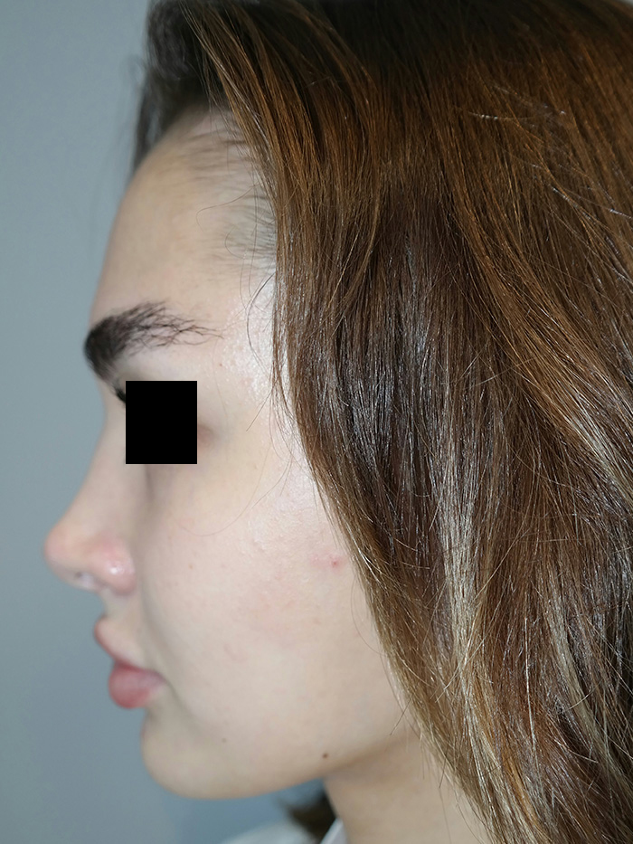 Rhinoplasty Before and After 05 | Grover Aesthetics