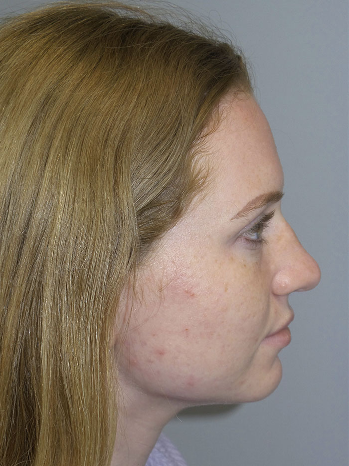 Rhinoplasty Before and After 15 | Sanjay Grover MD FACS