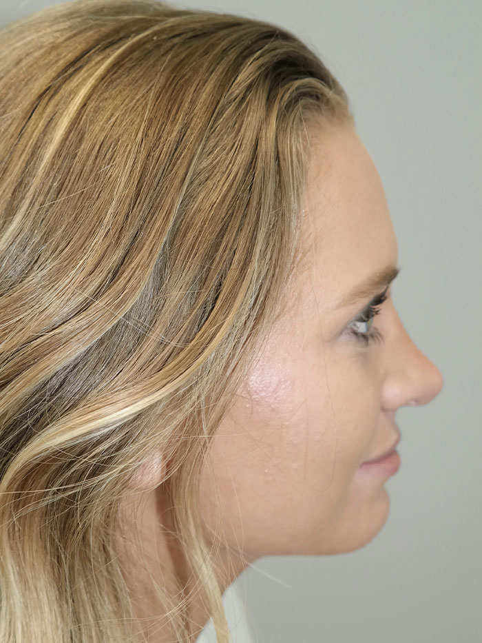 Rhinoplasty Before and After 06 | Sanjay Grover MD FACS