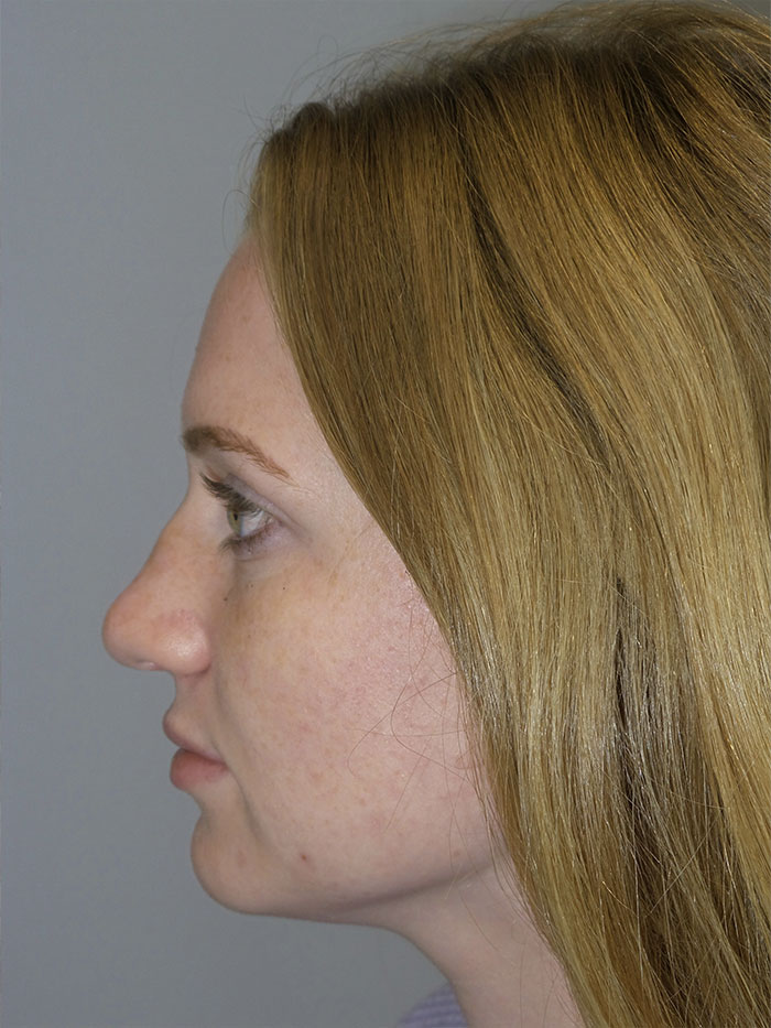 Rhinoplasty Before and After 06 | Grover Aesthetics