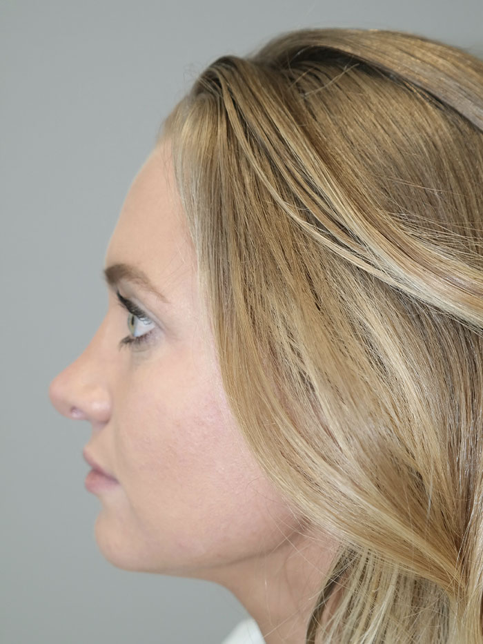 Rhinoplasty Before and After 06 | Grover Aesthetics