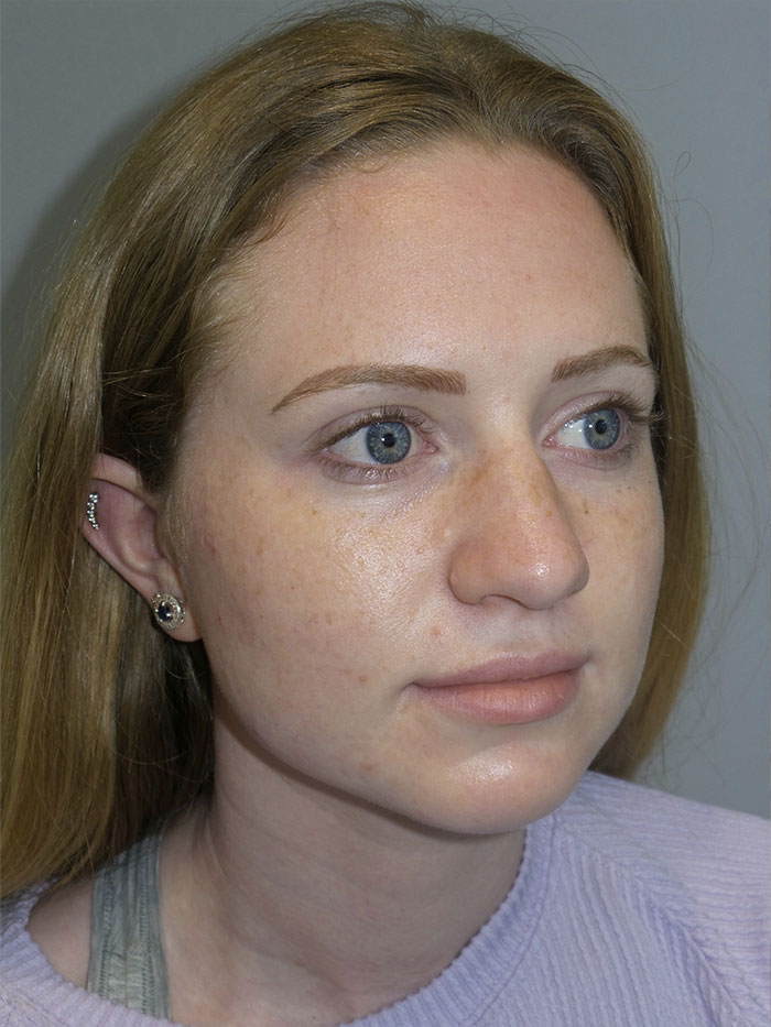 Rhinoplasty Before and After 06 | Grover Aesthetics