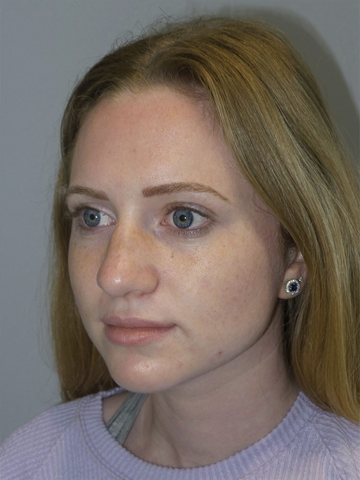 Rhinoplasty Before and After 06 | Grover Aesthetics