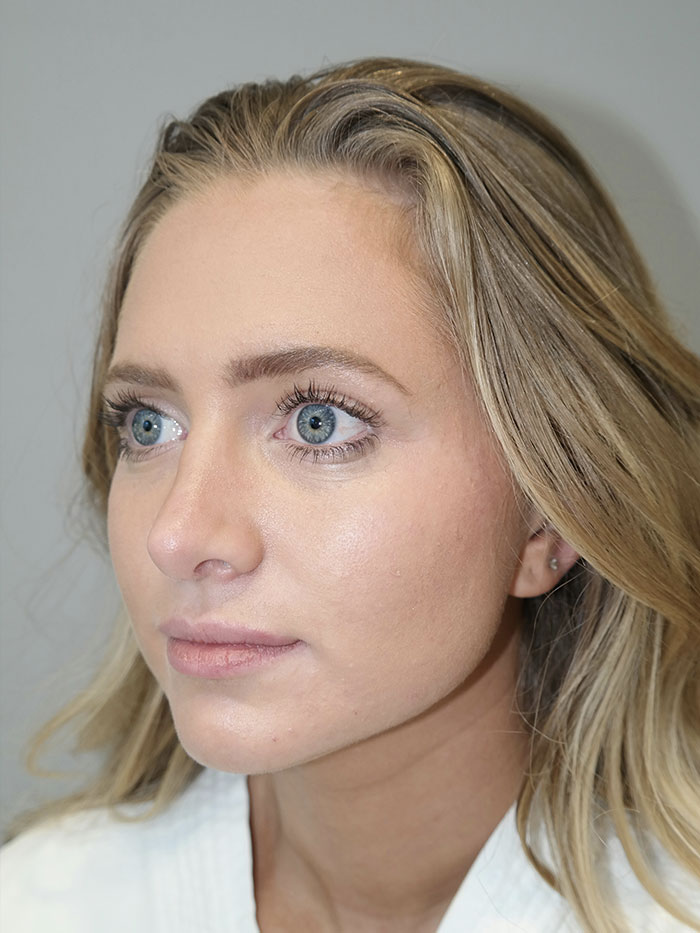 Rhinoplasty Before and After 06 | Grover Aesthetics