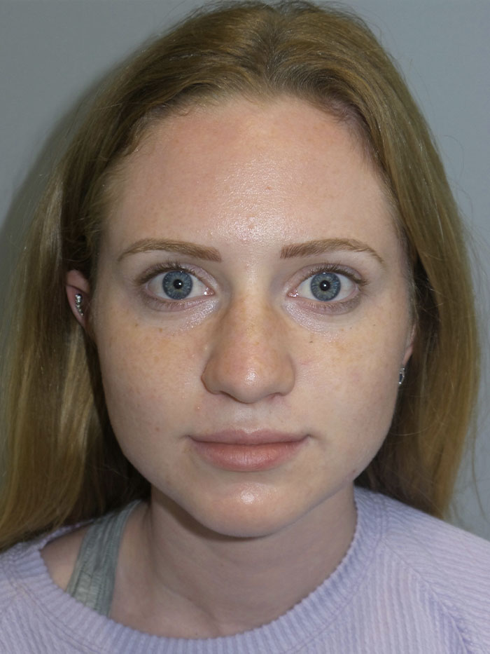 Rhinoplasty Before and After 06 | Grover Aesthetics