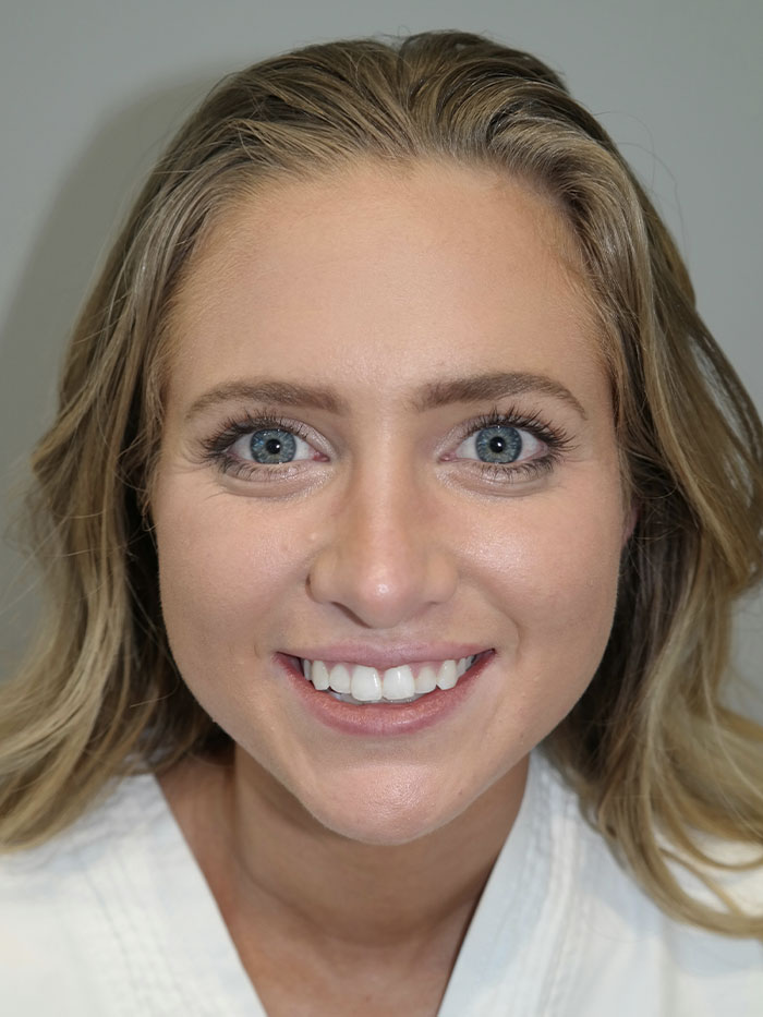 Rhinoplasty Before and After 06 | Grover Aesthetics