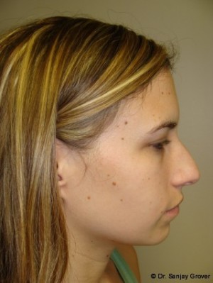 Rhinoplasty Before and After 18 | Sanjay Grover MD FACS