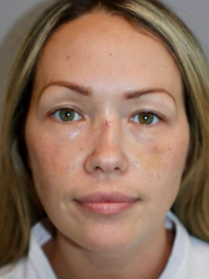 Rhinoplasty Before and After | Grover Aesthetics
