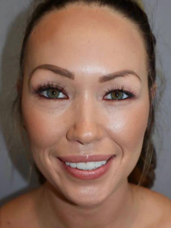 Rhinoplasty Before and After | Grover Aesthetics