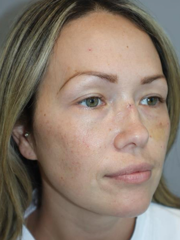 Rhinoplasty Before and After 08 | Grover Aesthetics