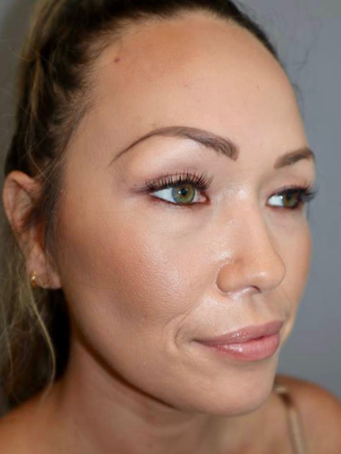 Rhinoplasty Before and After 08 | Grover Aesthetics
