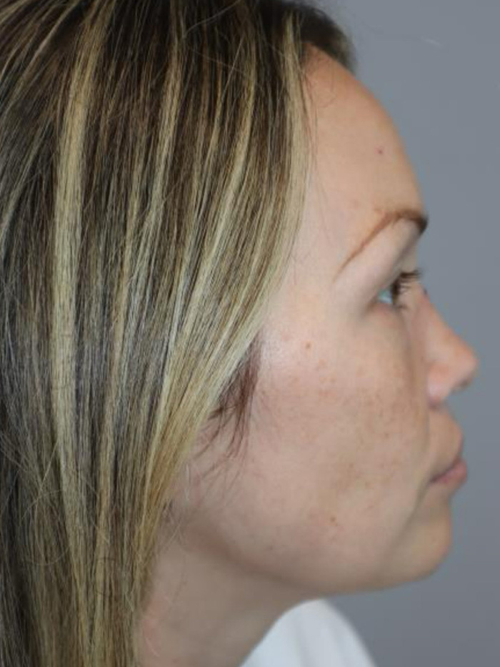 Rhinoplasty Before and After 08 | Grover Aesthetics