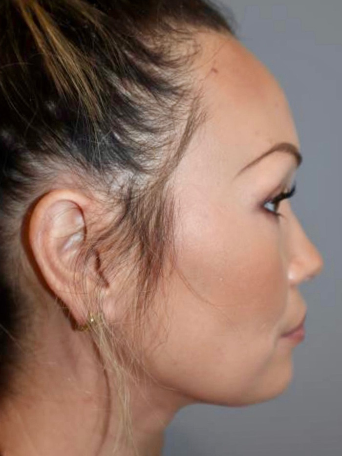 Rhinoplasty Before and After 08 | Grover Aesthetics