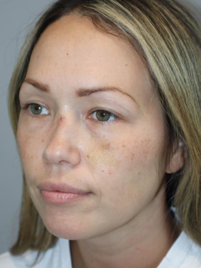 Rhinoplasty Before and After 08 | Grover Aesthetics