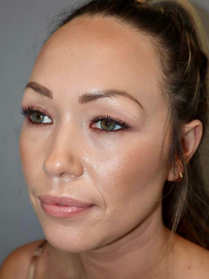 Rhinoplasty Before and After 08 | Grover Aesthetics
