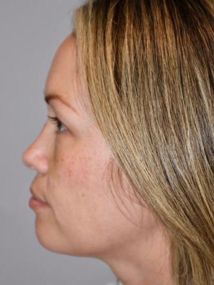Rhinoplasty Before and After 08 | Grover Aesthetics