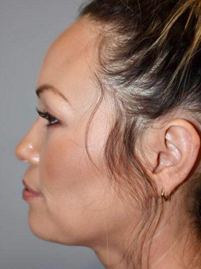 Rhinoplasty Before and After 08 | Grover Aesthetics
