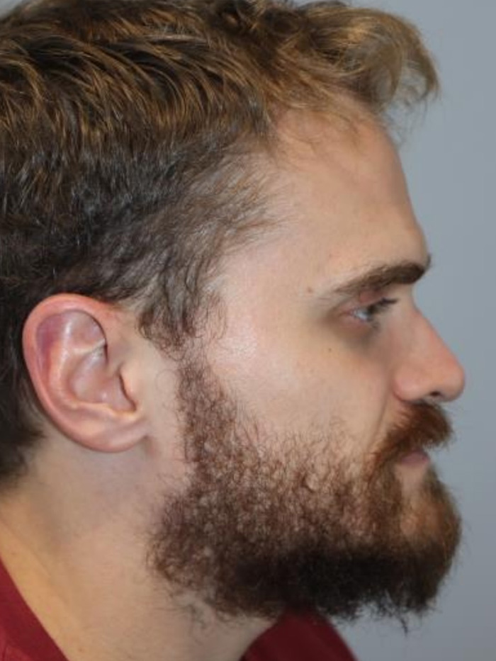 Rhinoplasty Before and After | Grover Aesthetics