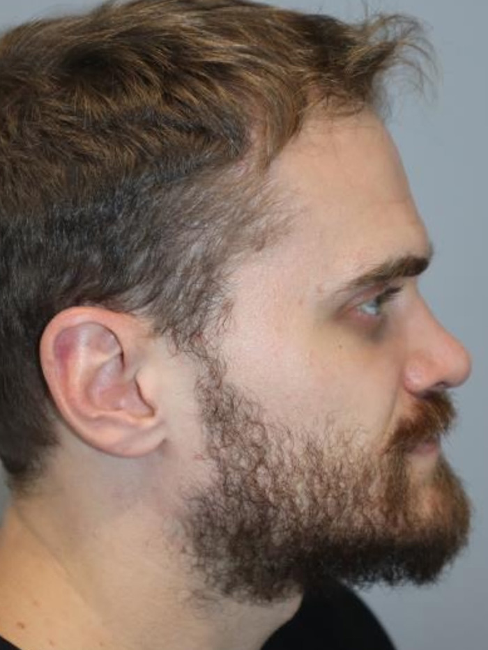 Rhinoplasty Before and After | Grover Aesthetics