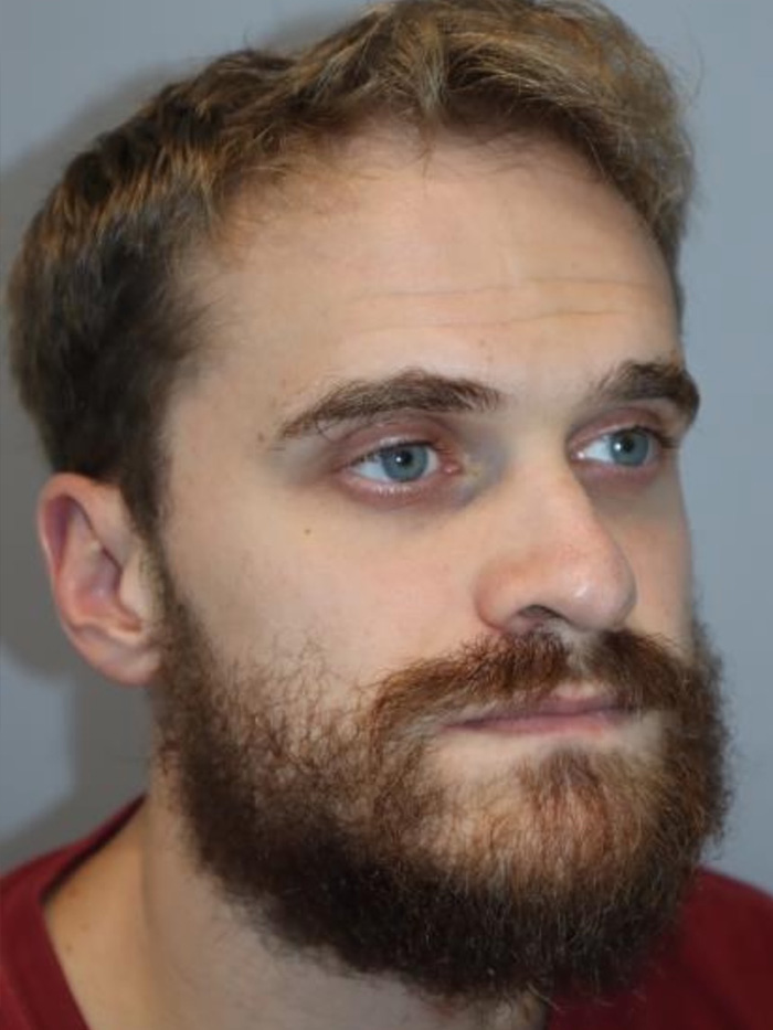 Rhinoplasty Before and After 09 | Grover Aesthetics