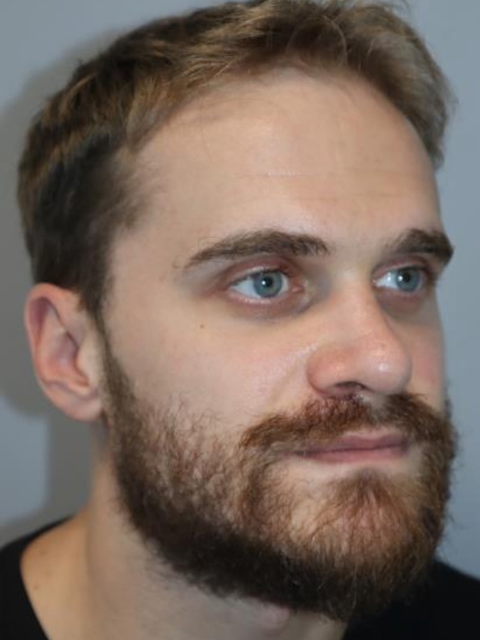 Rhinoplasty Before and After 09 | Grover Aesthetics
