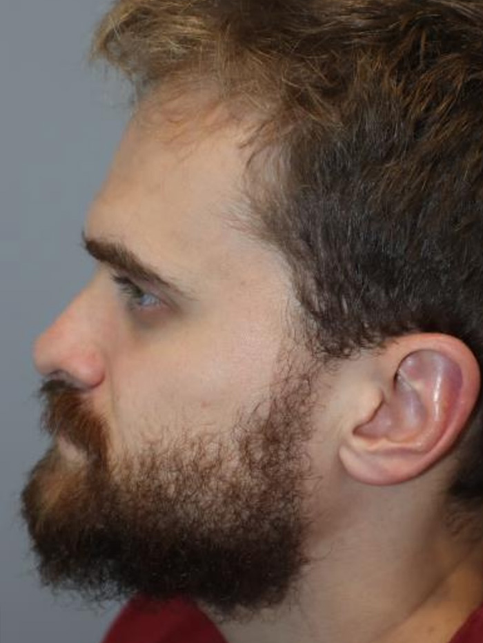 Rhinoplasty Before and After 09 | Grover Aesthetics