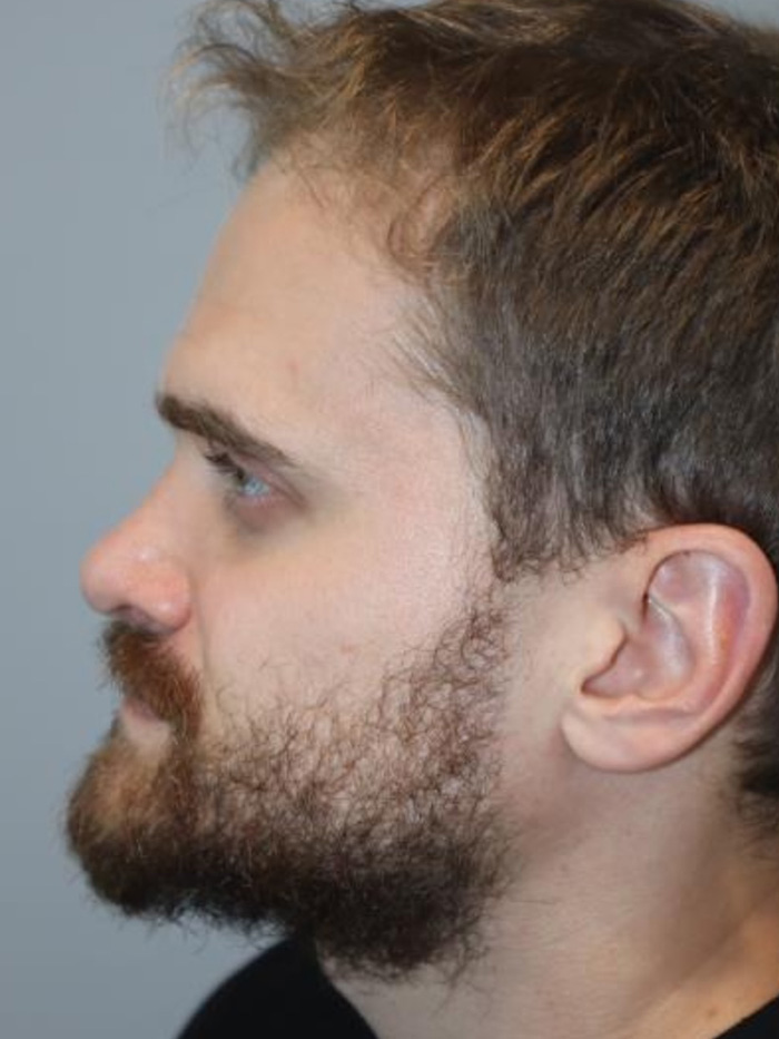 Rhinoplasty Before and After 09 | Grover Aesthetics