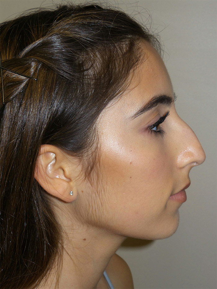 Rhinoplasty Before and After 38 | Sanjay Grover MD FACS