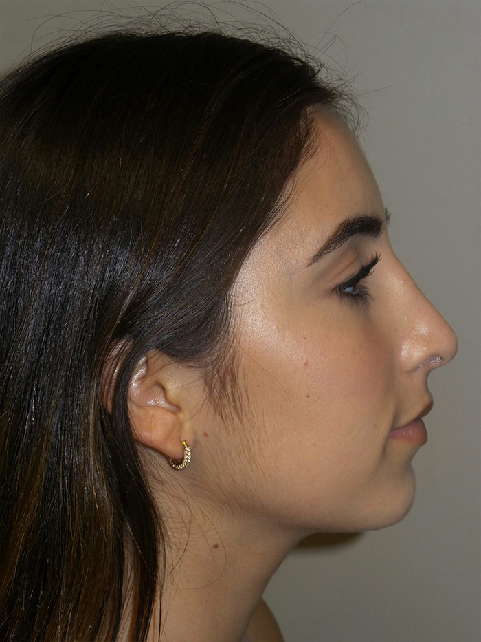 Rhinoplasty Before and After | Grover Aesthetics