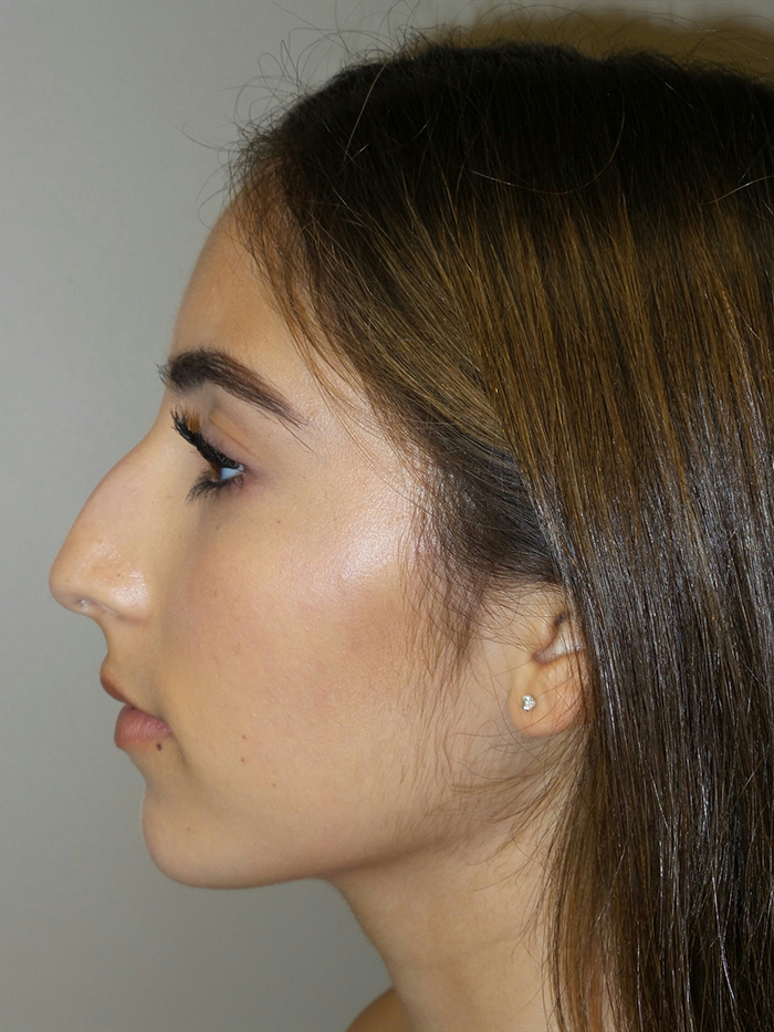 Rhinoplasty Before and After 10 | Sanjay Grover MD FACS